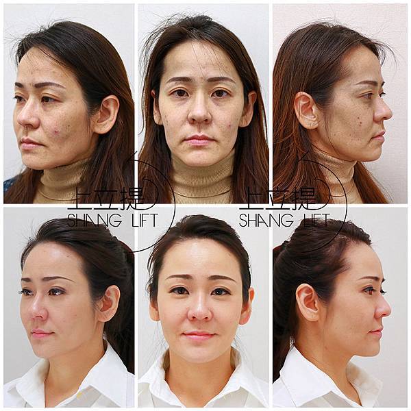 PicoSure755皮秒雷射蜂巢透鏡 皮秒雷射 二代皮秒上立皮膚科 費用 林上立 價格 林上立 評價 液態拉皮上立提 液態拉皮 推薦 少女計劃11 PicoSure755皮秒雷射蜂巢透鏡 皮秒雷射 二代皮秒上立皮膚科 費用 林上立 價格 林上立 評價 液態拉皮上立提 液態拉皮 推薦 少女計劃11