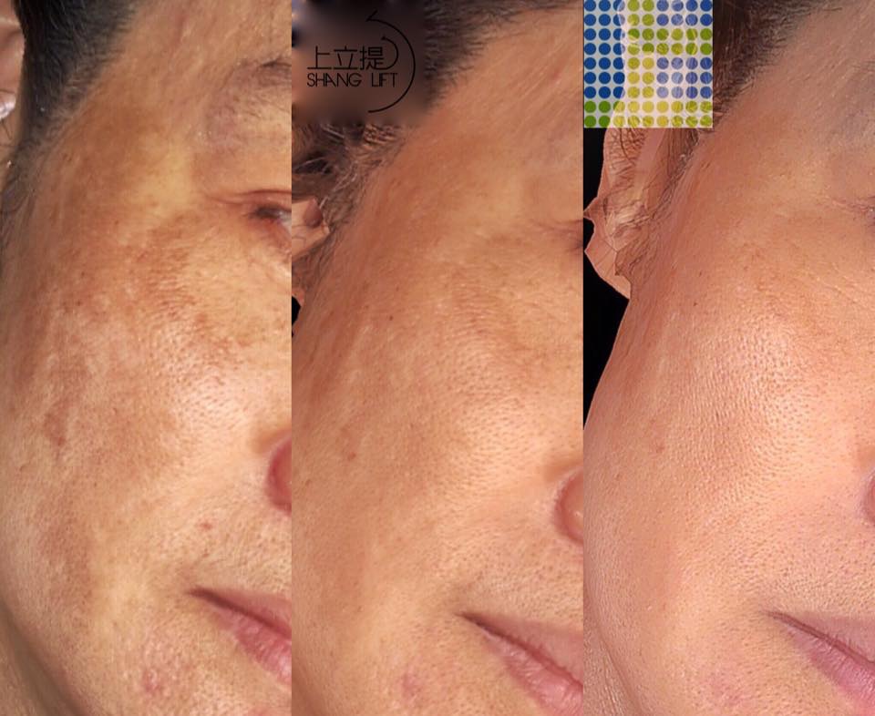 PicoSure755皮秒雷射蜂巢透鏡 皮秒雷射 二代皮秒上立皮膚科 費用 林上立 價格 林上立 評價 液態拉皮上立提 液態拉皮 推薦 少女計劃12 PicoSure755皮秒雷射蜂巢透鏡 皮秒雷射 二代皮秒上立皮膚科 費用 林上立 價格 林上立 評價 液態拉皮上立提 液態拉皮 推薦 少女計劃12