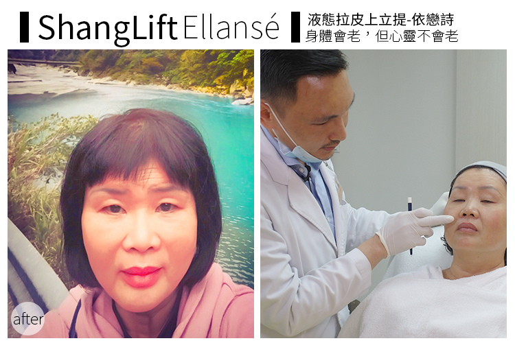 Ellansé依戀詩 液態拉皮§身體會老，但心靈不會│診間故事