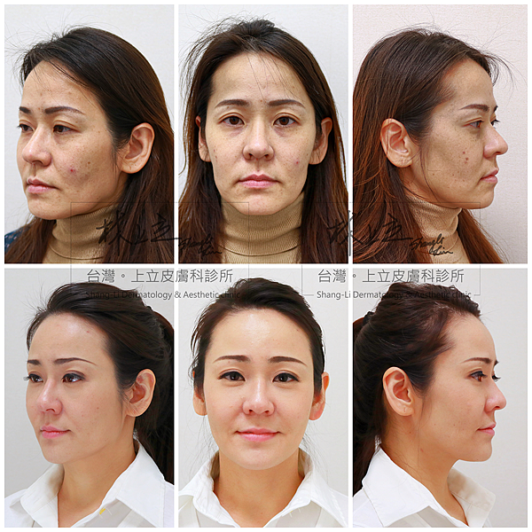 少女計劃林上立醫生液態拉皮上立提 液態拉皮 推薦 3D聚左旋乳酸 舒顏萃 童顏針 3D聚左旋乳酸 價格 3D聚左旋乳酸 費用 Ellansé 洢蓮絲少女針PolycaprolactonePCL膠原增生劑易麗適依戀詩.png 少女計劃林上立醫生液態拉皮上立提 液態拉皮 推薦 3D聚左旋乳酸 舒顏萃 童顏針 3D聚左旋乳酸 價格 3D聚左旋乳酸 費用 Ellansé 洢蓮絲少女針PolycaprolactonePCL膠原增生劑易麗適依戀詩.png