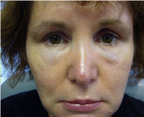 洢蓮絲依戀詩ellanse少女針淚溝眼袋2 洢蓮絲依戀詩ellanse少女針淚溝眼袋2