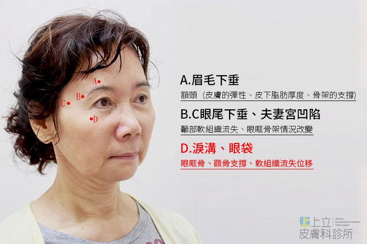 少女計劃林上立醫生液態拉皮上立提 液態拉皮 推薦 Ellansé 洢蓮絲少女針PolycaprolactonePCL膠原增生劑易麗適依戀詩聚己內酯05.jpg 少女計劃林上立醫生液態拉皮上立提 液態拉皮 推薦 Ellansé 洢蓮絲少女針PolycaprolactonePCL膠原增生劑易麗適依戀詩聚己內酯05.jpg