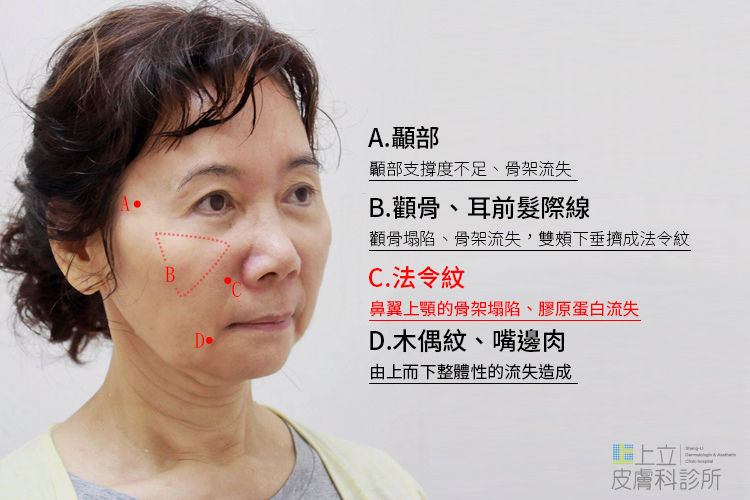 少女計劃林上立醫生液態拉皮上立提 液態拉皮 推薦 Ellansé 洢蓮絲少女針PolycaprolactonePCL膠原增生劑易麗適依戀詩聚己內酯法令紋改善05 少女計劃林上立醫生液態拉皮上立提 液態拉皮 推薦 Ellansé 洢蓮絲少女針PolycaprolactonePCL膠原增生劑易麗適依戀詩聚己內酯法令紋改善05