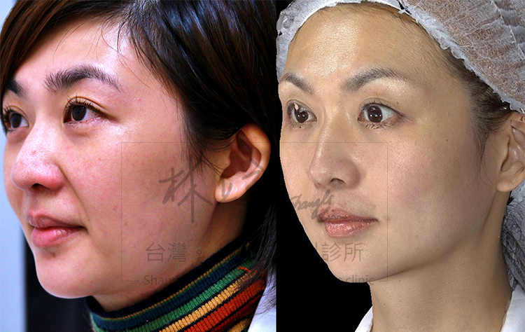 少女計劃林上立醫生液態拉皮上立提 液態拉皮 推薦 Ellansé 洢蓮絲少女針PolycaprolactonePCL膠原增生劑易麗適依戀詩聚己內酯法令紋改善08 少女計劃林上立醫生液態拉皮上立提 液態拉皮 推薦 Ellansé 洢蓮絲少女針PolycaprolactonePCL膠原增生劑易麗適依戀詩聚己內酯法令紋改善08