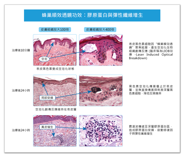 picosure755皮秒雷射蜂巢皮秒雷射蜂巢透鏡二代皮秒超皮秒新一代皮秒淨膚雷射飛梭雷射7.png