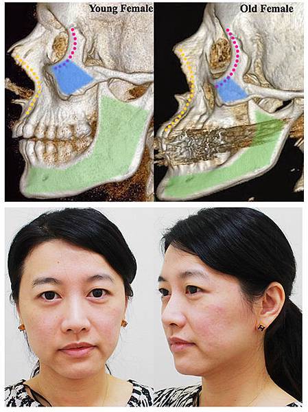 林上立醫生液態拉皮上立提Ellansé 洢蓮絲少女針PolycaprolactonePCL膠原增生劑易麗適依戀詩聚己內酯 洢蓮絲雙頰下垂蘋果肌拉提緊實01.jpg