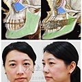 林上立醫生液態拉皮上立提Ellansé 洢蓮絲少女針PolycaprolactonePCL膠原增生劑易麗適依戀詩聚己內酯 洢蓮絲雙頰下垂蘋果肌拉提緊實01