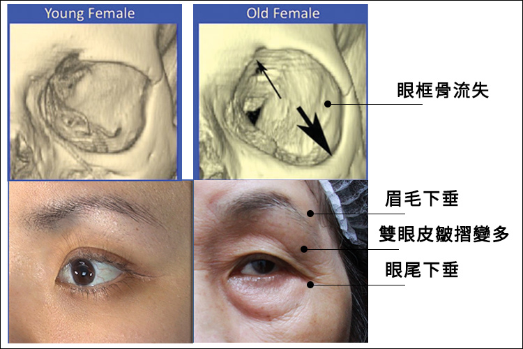 林上立醫生液態拉皮上立提Ellansé 洢蓮絲少女針PolycaprolactonePCL膠原增生劑易麗適依戀詩聚己內酯 洢蓮絲眼尾下垂 洢蓮絲眉毛下垂眼周緊實01 林上立醫生液態拉皮上立提Ellansé 洢蓮絲少女針PolycaprolactonePCL膠原增生劑易麗適依戀詩聚己內酯 洢蓮絲眼尾下垂 洢蓮絲眉毛下垂眼周緊實01