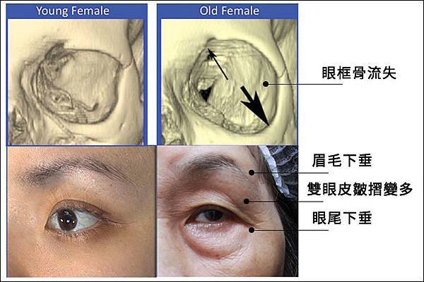 林上立醫生液態拉皮上立提Ellansé 洢蓮絲少女針PolycaprolactonePCL膠原增生劑易麗適依戀詩聚己內酯 洢蓮絲眼尾下垂 洢蓮絲眉毛下垂眼周緊實01