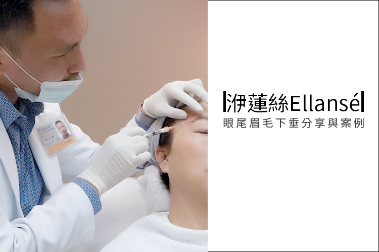 林上立醫生液態拉皮上立提Ellansé 洢蓮絲少女針PolycaprolactonePCL膠原增生劑易麗適依戀詩聚己內酯 洢蓮絲眼尾下垂 洢蓮絲眉毛下垂眼周緊實 林上立醫生液態拉皮上立提Ellansé 洢蓮絲少女針PolycaprolactonePCL膠原增生劑易麗適依戀詩聚己內酯 洢蓮絲眼尾下垂 洢蓮絲眉毛下垂眼周緊實