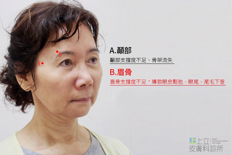 林上立醫生液態拉皮上立提Ellansé 洢蓮絲少女針PolycaprolactonePCL膠原增生劑易麗適依戀詩聚己內酯 洢蓮絲眼尾下垂 洢蓮絲眉毛下垂眼周緊實04 林上立醫生液態拉皮上立提Ellansé 洢蓮絲少女針PolycaprolactonePCL膠原增生劑易麗適依戀詩聚己內酯 洢蓮絲眼尾下垂 洢蓮絲眉毛下垂眼周緊實04