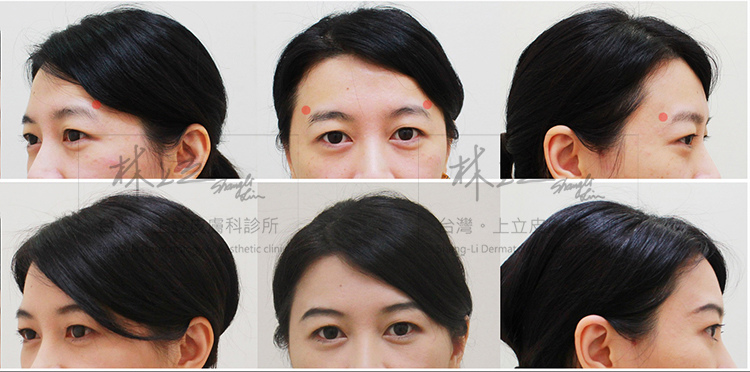 林上立醫生液態拉皮上立提Ellansé 洢蓮絲少女針PolycaprolactonePCL膠原增生劑易麗適依戀詩聚己內酯 洢蓮絲眼尾下垂 洢蓮絲眉毛下垂眼周緊實08 林上立醫生液態拉皮上立提Ellansé 洢蓮絲少女針PolycaprolactonePCL膠原增生劑易麗適依戀詩聚己內酯 洢蓮絲眼尾下垂 洢蓮絲眉毛下垂眼周緊實08