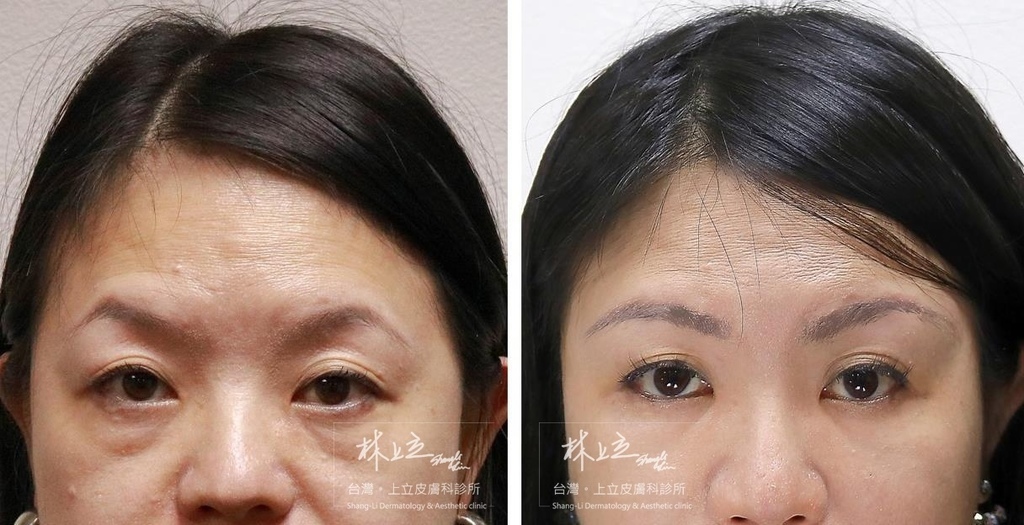 林上立醫生液態拉皮上立提Ellansé 洢蓮絲少女針PolycaprolactonePCL膠原增生劑易麗適依戀詩聚己內酯 洢蓮絲眼尾下垂 洢蓮絲眉毛下垂眼周緊實05 林上立醫生液態拉皮上立提Ellansé 洢蓮絲少女針PolycaprolactonePCL膠原增生劑易麗適依戀詩聚己內酯 洢蓮絲眼尾下垂 洢蓮絲眉毛下垂眼周緊實05