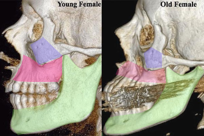 facial-bones-110105-02.png facial-bones-110105-02.png
