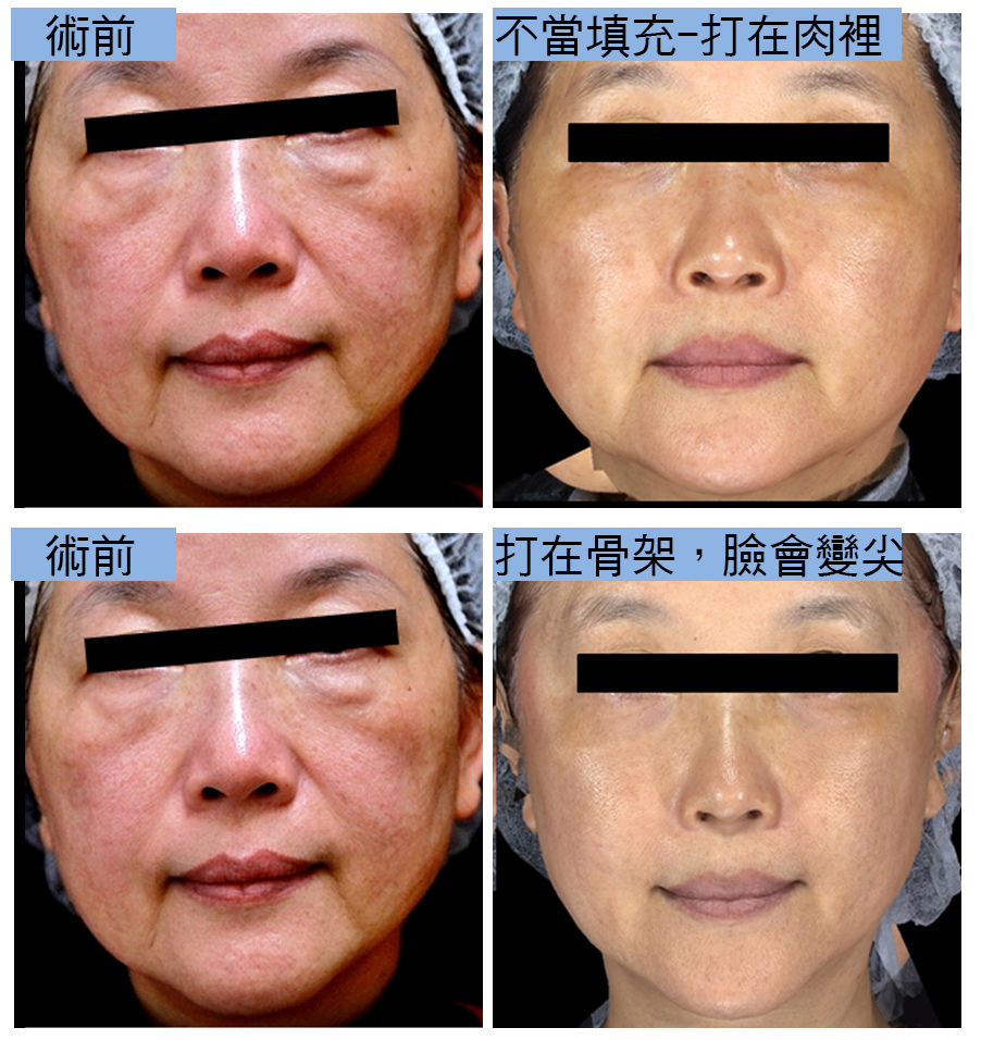 液態拉皮上立提洢蓮絲ellanse依戀詩聚己內酯少女針易麗適06.jpg 液態拉皮上立提洢蓮絲ellanse依戀詩聚己內酯少女針易麗適06.jpg