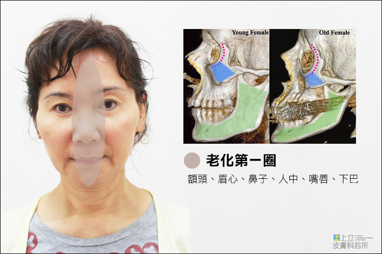林上立醫生液態拉皮上立提Ellansé 洢蓮絲少女針PolycaprolactonePCL膠原增生劑易麗適依戀詩聚己內酯 洢蓮絲眼尾下垂 洢蓮絲隆鼻墊下巴豐額額頭01.jpg 林上立醫生液態拉皮上立提Ellansé 洢蓮絲少女針PolycaprolactonePCL膠原增生劑易麗適依戀詩聚己內酯 洢蓮絲眼尾下垂 洢蓮絲隆鼻墊下巴豐額額頭01.jpg