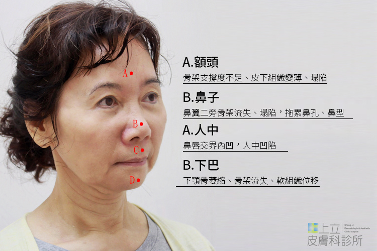 林上立醫生液態拉皮上立提Ellansé 洢蓮絲少女針PolycaprolactonePCL膠原增生劑易麗適依戀詩聚己內酯 洢蓮絲眼尾下垂 洢蓮絲隆鼻墊下巴豐額額頭03.jpg 林上立醫生液態拉皮上立提Ellansé 洢蓮絲少女針PolycaprolactonePCL膠原增生劑易麗適依戀詩聚己內酯 洢蓮絲眼尾下垂 洢蓮絲隆鼻墊下巴豐額額頭03.jpg
