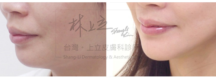 林上立醫生液態拉皮上立提Ellansé 洢蓮絲少女針PolycaprolactonePCL膠原增生劑易麗適依戀詩聚己內酯 洢蓮絲眼尾下垂 洢蓮絲隆鼻墊下巴豐額額頭05.jpg 林上立醫生液態拉皮上立提Ellansé 洢蓮絲少女針PolycaprolactonePCL膠原增生劑易麗適依戀詩聚己內酯 洢蓮絲眼尾下垂 洢蓮絲隆鼻墊下巴豐額額頭05.jpg