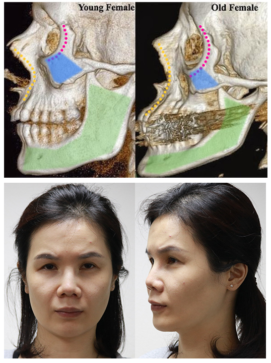 林上立醫生液態拉皮上立提Ellansé 洢蓮絲少女針PolycaprolactonePCL膠原增生劑易麗適依戀詩聚己內酯 洢蓮絲雙頰凹陷洢蓮絲豐頰洢蓮絲蘋果肌02.jpg 林上立醫生液態拉皮上立提Ellansé 洢蓮絲少女針PolycaprolactonePCL膠原增生劑易麗適依戀詩聚己內酯 洢蓮絲雙頰凹陷洢蓮絲豐頰洢蓮絲蘋果肌02.jpg