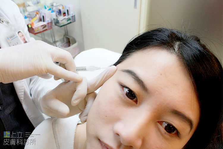 林上立醫生液態拉皮上立提Ellansé 洢蓮絲少女針PolycaprolactonePCL膠原增生劑易麗適依戀詩聚己內酯 洢蓮絲雙頰凹陷洢蓮絲豐頰洢蓮絲蘋果肌05 林上立醫生液態拉皮上立提Ellansé 洢蓮絲少女針PolycaprolactonePCL膠原增生劑易麗適依戀詩聚己內酯 洢蓮絲雙頰凹陷洢蓮絲豐頰洢蓮絲蘋果肌05