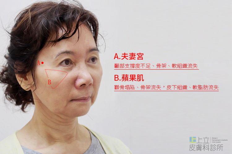 林上立醫生液態拉皮上立提Ellansé 洢蓮絲少女針PolycaprolactonePCL膠原增生劑易麗適依戀詩聚己內酯 洢蓮絲雙頰凹陷洢蓮絲豐頰洢蓮絲蘋果肌06 林上立醫生液態拉皮上立提Ellansé 洢蓮絲少女針PolycaprolactonePCL膠原增生劑易麗適依戀詩聚己內酯 洢蓮絲雙頰凹陷洢蓮絲豐頰洢蓮絲蘋果肌06