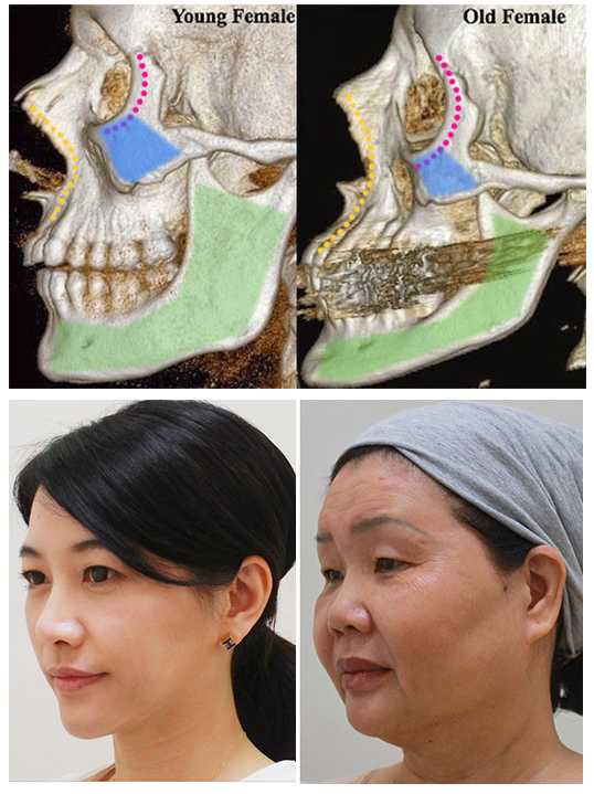 林上立醫生液態拉皮上立提Ellansé 洢蓮絲少女針PolycaprolactonePCL膠原增生劑易麗適依戀詩聚己內酯 洢蓮絲下顎線拉提01 林上立醫生液態拉皮上立提Ellansé 洢蓮絲少女針PolycaprolactonePCL膠原增生劑易麗適依戀詩聚己內酯 洢蓮絲下顎線拉提01