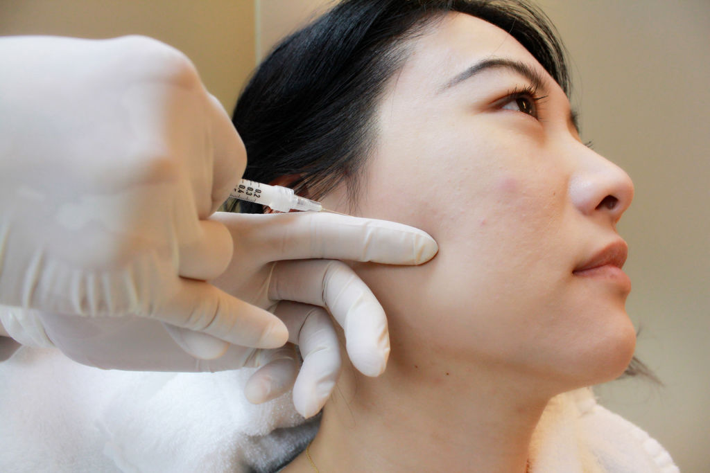 林上立醫生液態拉皮上立提Ellansé 洢蓮絲少女針PolycaprolactonePCL膠原增生劑易麗適依戀詩聚己內酯 洢蓮絲下顎線拉提04 林上立醫生液態拉皮上立提Ellansé 洢蓮絲少女針PolycaprolactonePCL膠原增生劑易麗適依戀詩聚己內酯 洢蓮絲下顎線拉提04