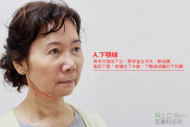 林上立醫生液態拉皮上立提Ellansé 洢蓮絲少女針PolycaprolactonePCL膠原增生劑易麗適依戀詩聚己內酯 洢蓮絲下顎線拉提05 林上立醫生液態拉皮上立提Ellansé 洢蓮絲少女針PolycaprolactonePCL膠原增生劑易麗適依戀詩聚己內酯 洢蓮絲下顎線拉提05
