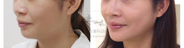 林上立醫生液態拉皮上立提Ellansé 洢蓮絲少女針PolycaprolactonePCL膠原增生劑易麗適依戀詩聚己內酯 洢蓮絲下顎線拉提10 林上立醫生液態拉皮上立提Ellansé 洢蓮絲少女針PolycaprolactonePCL膠原增生劑易麗適依戀詩聚己內酯 洢蓮絲下顎線拉提10