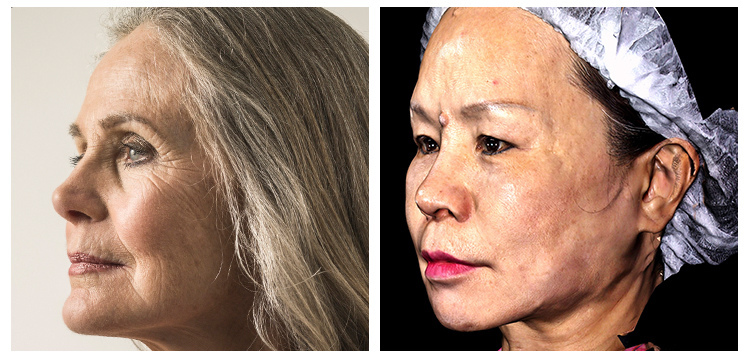 IMCAS上立醫生液態拉皮上立提Ellansé 洢蓮絲少女針PolycaprolactonePCL膠原增生劑易麗適依戀詩聚己內酯03.jpg IMCAS上立醫生液態拉皮上立提Ellansé 洢蓮絲少女針PolycaprolactonePCL膠原增生劑易麗適依戀詩聚己內酯03.jpg