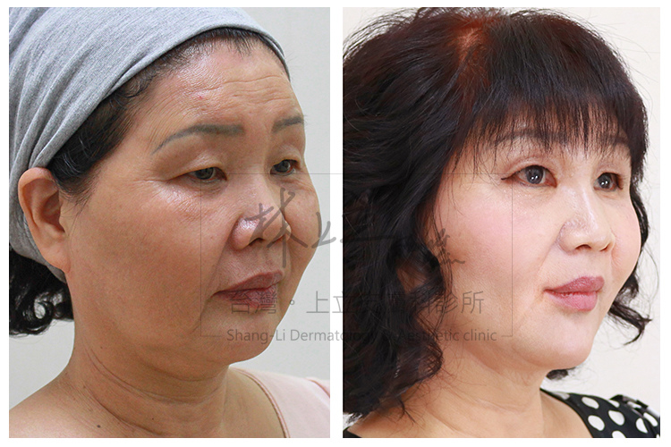 IMCAS上立醫生液態拉皮上立提Ellansé 洢蓮絲少女針PolycaprolactonePCL膠原增生劑易麗適依戀詩聚己內酯04.jpg IMCAS上立醫生液態拉皮上立提Ellansé 洢蓮絲少女針PolycaprolactonePCL膠原增生劑易麗適依戀詩聚己內酯04.jpg