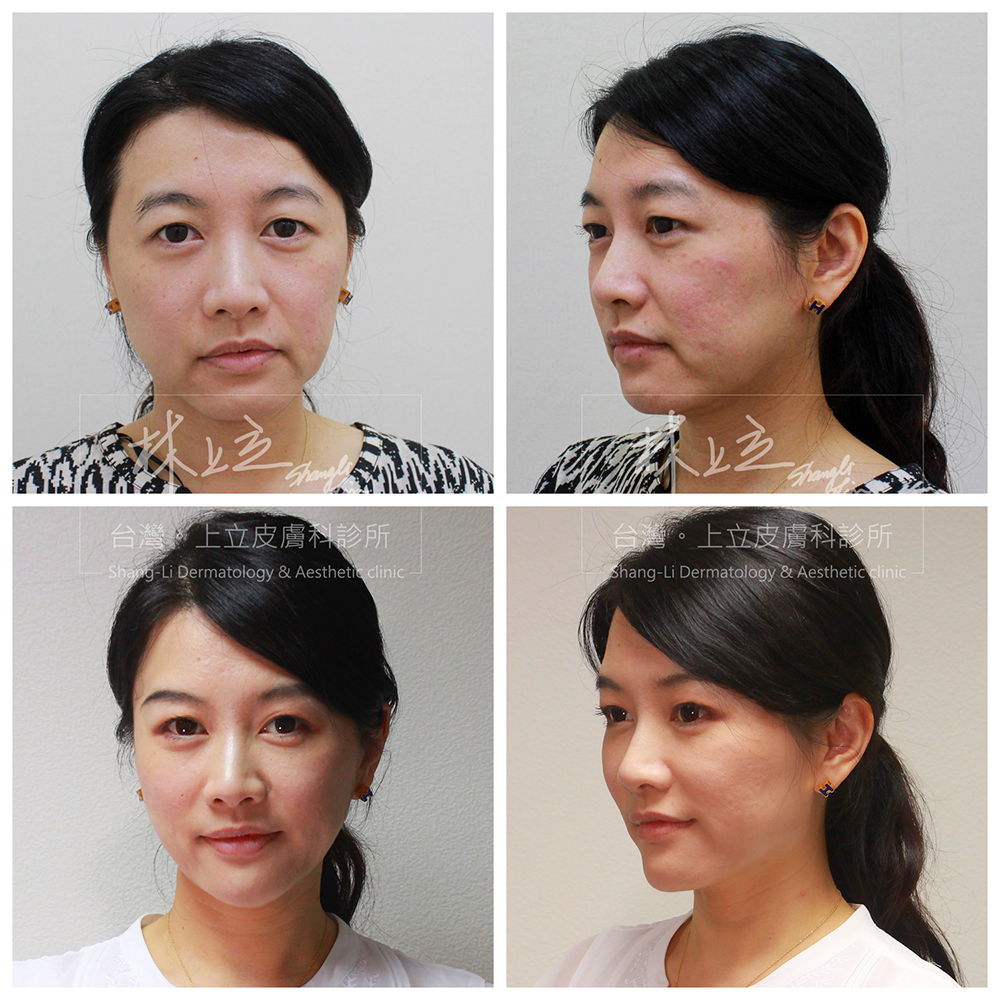 IMCAS上立醫生液態拉皮上立提Ellansé 洢蓮絲少女針PolycaprolactonePCL膠原增生劑易麗適依戀詩聚己內酯04 IMCAS上立醫生液態拉皮上立提Ellansé 洢蓮絲少女針PolycaprolactonePCL膠原增生劑易麗適依戀詩聚己內酯04