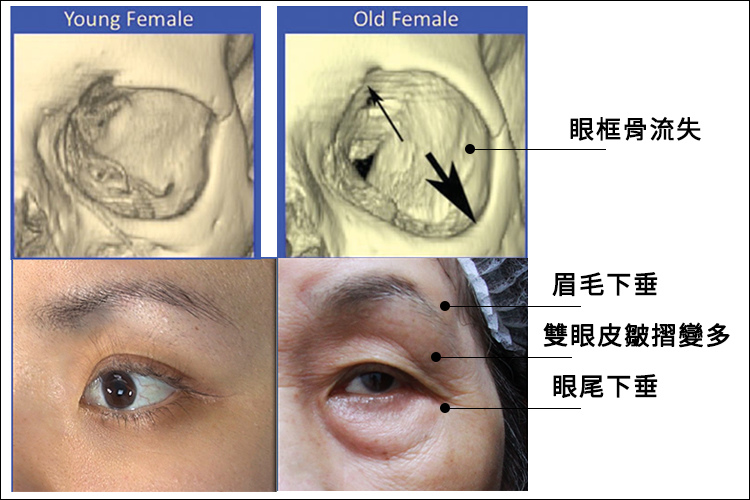 IMCAS上立醫生液態拉皮上立提Ellansé 洢蓮絲少女針PolycaprolactonePCL膠原增生劑易麗適依戀詩聚己內酯03.jpg