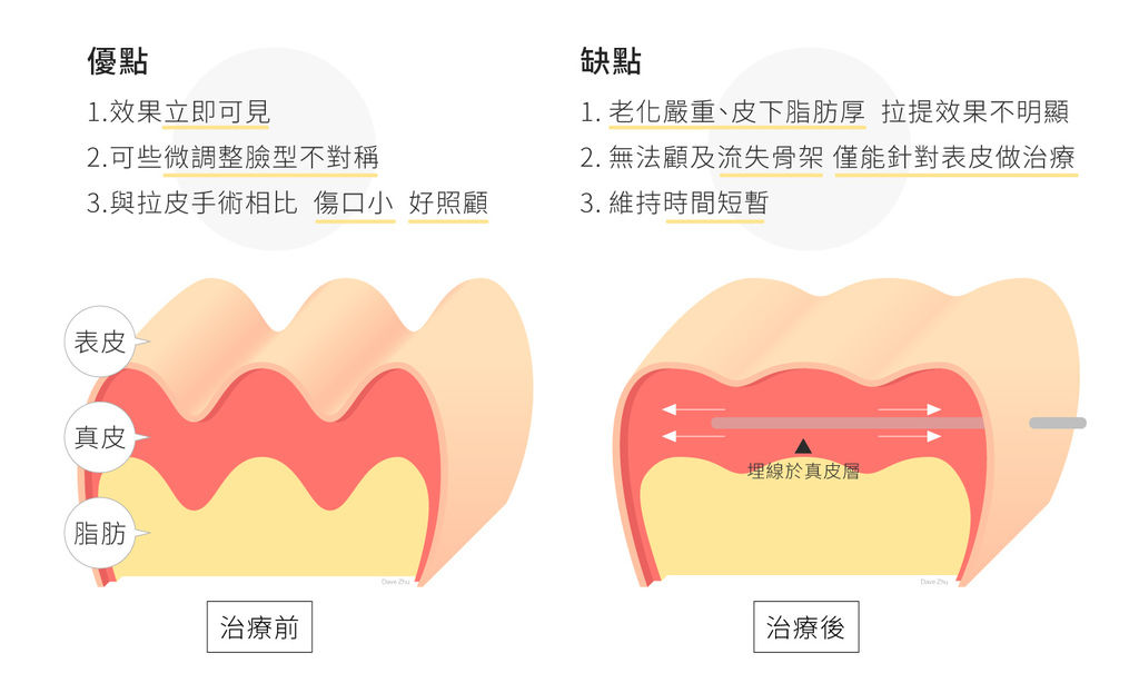 林上立醫生液態拉皮上立提Ellansé 洢蓮絲少女針PolycaprolactonePCL膠原增生劑易麗適依戀詩聚己內酯埋線拉皮3D聚左旋乳酸童顏針舒顏萃01