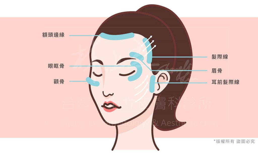 林上立醫生液態拉皮上立提Ellansé 洢蓮絲少女針PolycaprolactonePCL膠原增生劑易麗適依戀詩聚己內酯埋線拉皮3D聚左旋乳酸童顏針舒顏萃005.jpg