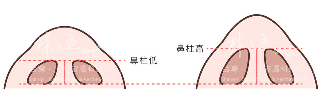 洢蓮絲依戀詩隆鼻山根玻尿酸隆鼻微晶瓷隆鼻晶亮慈隆鼻4.jpg