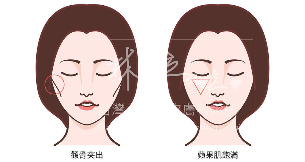林上立醫生液態拉皮上立提Ellansé 洢蓮絲少女針PolycaprolactonePCL膠原增生劑易麗適依戀詩聚己內酯3D聚左旋乳酸童顏針舒顏萃蘋果肌01.jpg 林上立醫生液態拉皮上立提Ellansé 洢蓮絲少女針PolycaprolactonePCL膠原增生劑易麗適依戀詩聚己內酯3D聚左旋乳酸童顏針舒顏萃蘋果肌01.jpg