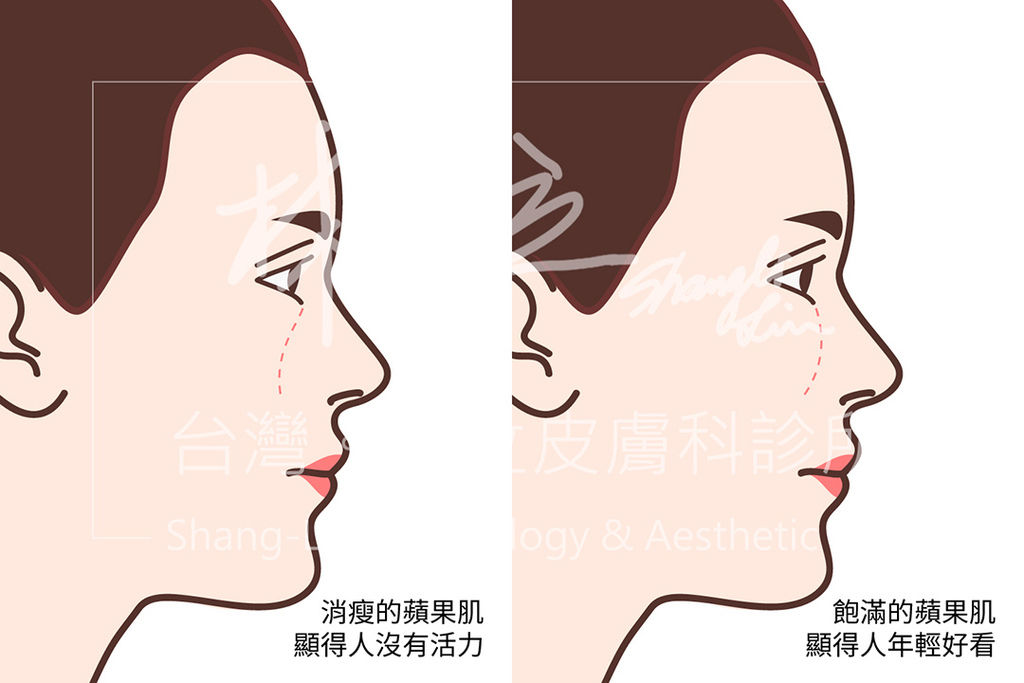 林上立醫生液態拉皮上立提Ellansé 洢蓮絲少女針PolycaprolactonePCL膠原增生劑易麗適依戀詩聚己內酯3D聚左旋乳酸童顏針舒顏萃蘋果肌03.jpg 林上立醫生液態拉皮上立提Ellansé 洢蓮絲少女針PolycaprolactonePCL膠原增生劑易麗適依戀詩聚己內酯3D聚左旋乳酸童顏針舒顏萃蘋果肌03.jpg