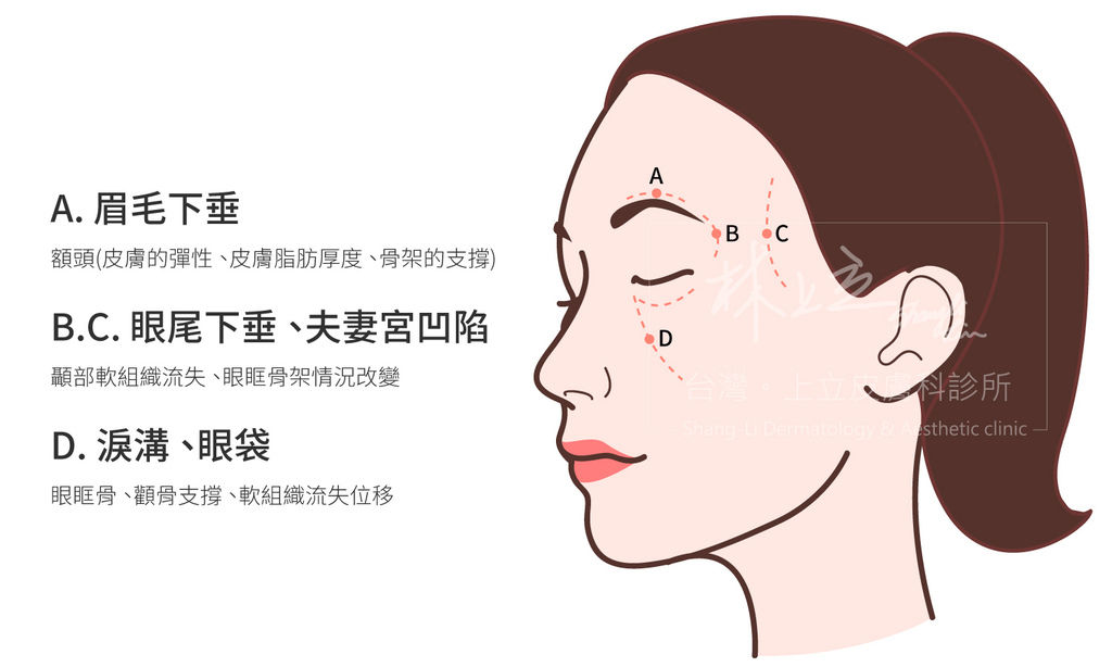 林上立醫生液態拉皮上立提Ellansé 洢蓮絲少女針PolycaprolactonePCL膠原增生劑易麗適依戀詩聚己內酯 洢蓮絲淚溝洢蓮絲眼袋皮秒雷射細紋755皮秒雷射蜂巢透鏡01.jpg