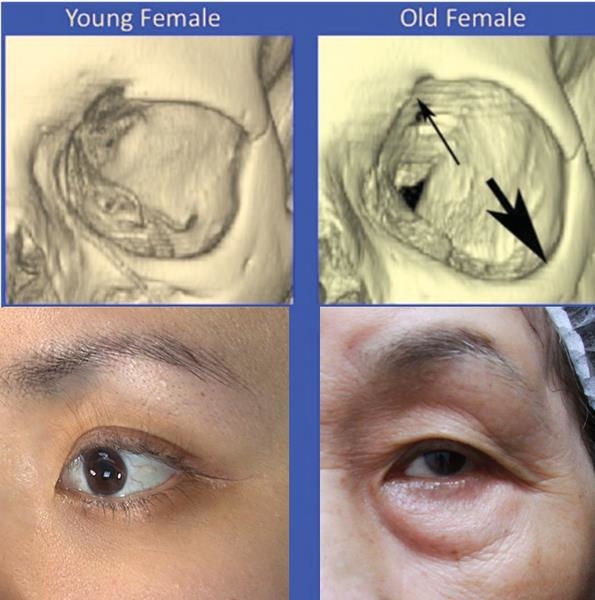 林上立醫生液態拉皮上立提Ellansé 洢蓮絲少女針PolycaprolactonePCL膠原增生劑易麗適依戀詩聚己內酯 洢蓮絲淚溝洢蓮絲眼袋皮秒雷射細紋755皮秒雷射蜂巢透鏡03.jpg 林上立醫生液態拉皮上立提Ellansé 洢蓮絲少女針PolycaprolactonePCL膠原增生劑易麗適依戀詩聚己內酯 洢蓮絲淚溝洢蓮絲眼袋皮秒雷射細紋755皮秒雷射蜂巢透鏡03.jpg