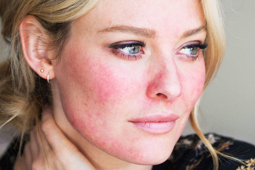 PicoSure蜂巢皮秒除皺雷射蜂巢皮秒機械光755皮秒雷射蜂巢瞬效透鏡蜂巢透鏡除斑太田母斑顴骨母斑胎記除斑雷射02.jpg PicoSure蜂巢皮秒除皺雷射蜂巢皮秒機械光755皮秒雷射蜂巢瞬效透鏡蜂巢透鏡除斑太田母斑顴骨母斑胎記除斑雷射02.jpg