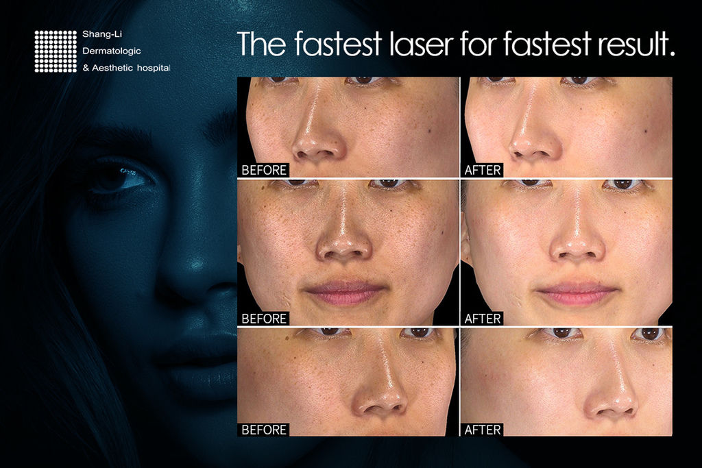 PicoSure蜂巢皮秒除皺雷射蜂巢皮秒機械光755皮秒雷射蜂巢瞬效透鏡蜂巢透鏡除斑太田母斑顴骨母斑胎記除斑雷射03.jpg PicoSure蜂巢皮秒除皺雷射蜂巢皮秒機械光755皮秒雷射蜂巢瞬效透鏡蜂巢透鏡除斑太田母斑顴骨母斑胎記除斑雷射03.jpg