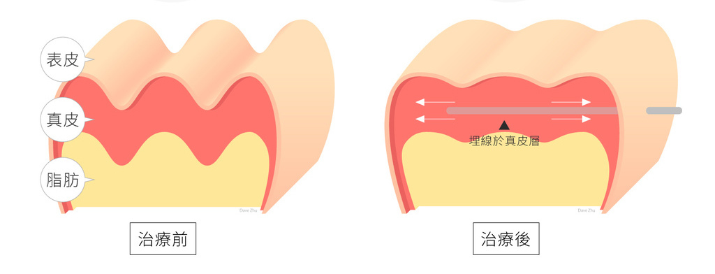 液態拉皮上立提Ellansé 洢蓮絲少女針PolycaprolactonePCL膠原增生劑易麗適依戀詩聚己內酯 洢蓮絲雙頰下垂蘋果肌拉提緊實04.jpg