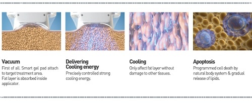 冷凍減脂MICOOL低溫輔助減脂馬甲線六塊肌抽脂冷凍溶脂5.jpg