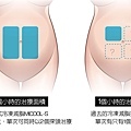 冷凍溶脂冷凍減脂非侵入式體雕抽脂副作用肚子瘦手臂大腿5