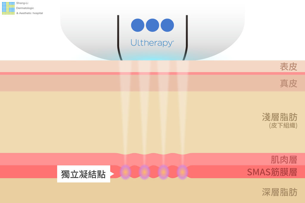 超音波拉提超音波拉皮超聲刀極線音波拉皮極線音波拉提筋膜拉皮下顎線費用價位推薦效果美國機音波拉皮因波拉提術後保養腫推薦醫師林上立上立皮膚科診所多少錢幾條液態拉皮(2).jpg