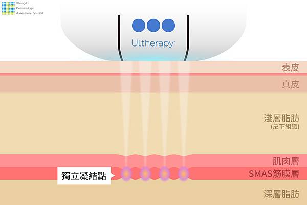 超音波拉提超音波拉皮超聲刀極線音波拉皮極線音波拉提筋膜拉皮下顎線費用價位推薦效果美國機音波拉皮因波拉提術後保養腫推薦醫師林上立上立皮膚科診所多少錢幾條液態拉皮(2).jpg