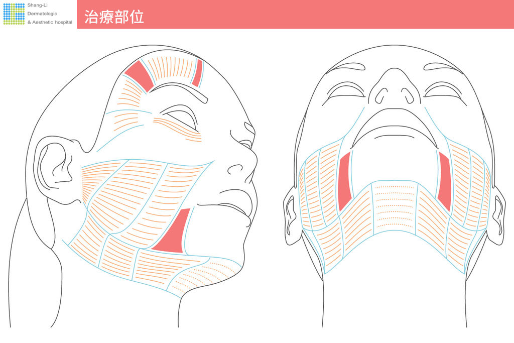 超音波拉提超音波拉皮超聲刀極線音波拉皮極線音波拉提筋膜拉皮下顎線費用價位推薦效果美國機音波拉皮因波拉提術後保養腫推薦醫師林上立上立皮膚科診所多少錢幾條液態拉皮(3).jpg