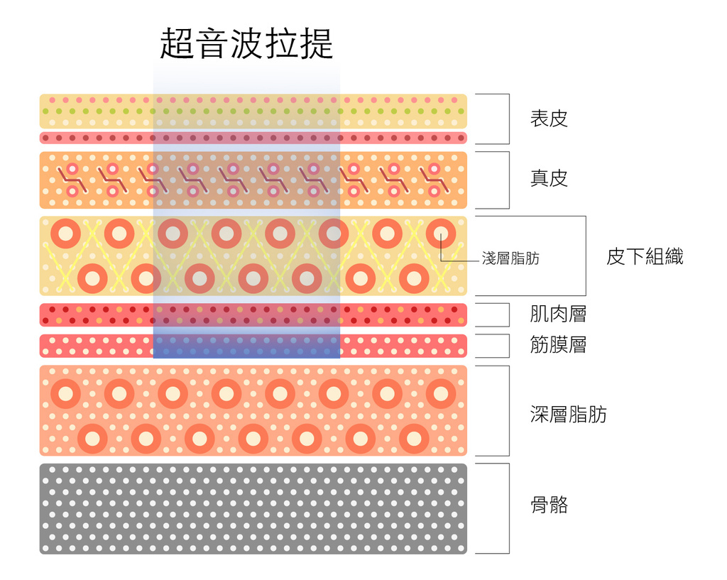 超音波拉提超音波拉皮超聲刀極線音波拉皮極線音波拉提筋膜拉皮下顎線費用價位推薦效果美國機音波拉皮因波拉提術後保養腫推薦醫師林上立上立皮膚科診所多少錢幾條液態拉皮(6).jpg