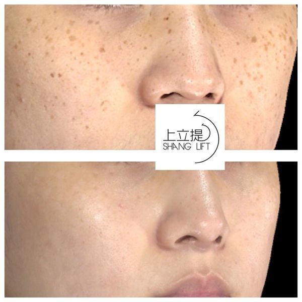 防曬紫外線SPF防曬乳挑選PA+++皮秒雷射755蜂巢皮秒雷射蜂巢透鏡picoSure新一代皮秒超皮秒雷射4.jpg 防曬紫外線SPF防曬乳挑選PA+++皮秒雷射755蜂巢皮秒雷射蜂巢透鏡picoSure新一代皮秒超皮秒雷射4.jpg